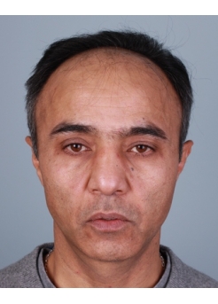 Before Hair Transplant&nbsp;Front